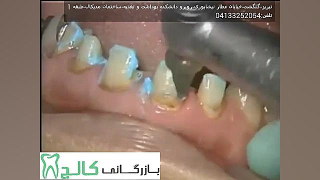 سمان رزینی دوال کیور پرایم دنت