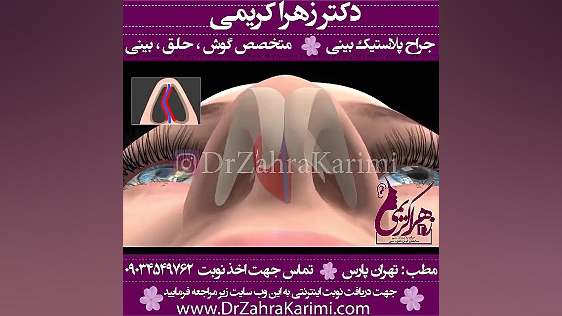 جراحی انحراف بینی (سیتوپلاستی)