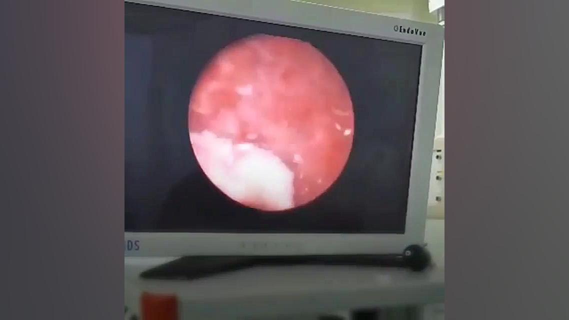 تومور یا سرطان مثانه  دکتر میر...