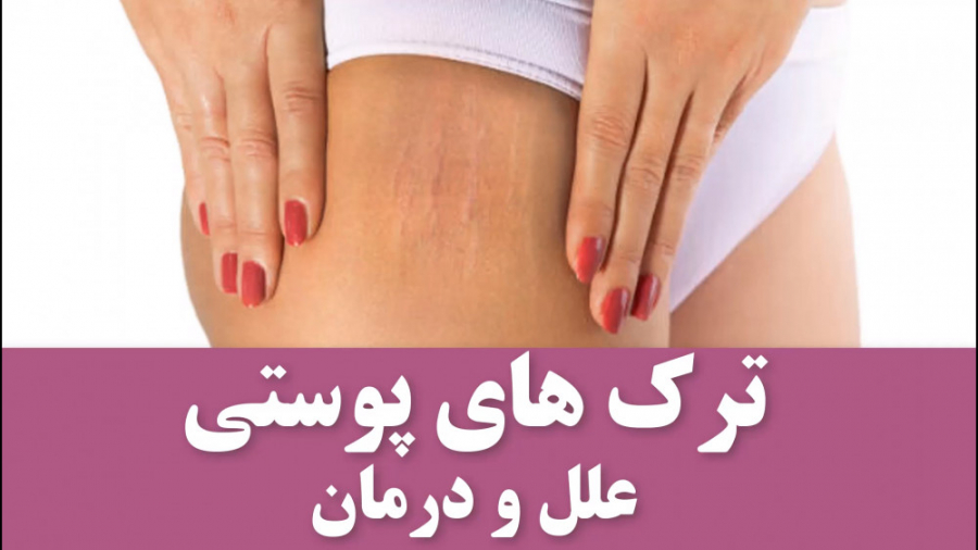 علت ایجاد ترک های پوستی و بهتر...