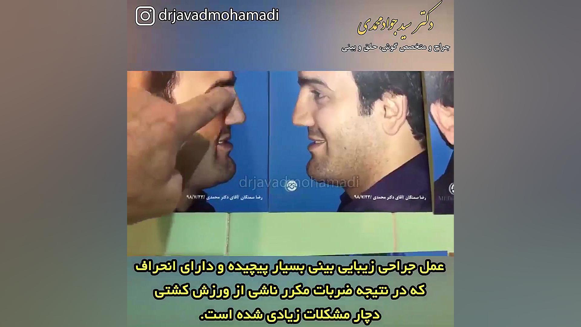 جراحی بینی بسیار پیچیده