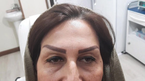 تزریق بوتاکس بعد از ۲ هفته
