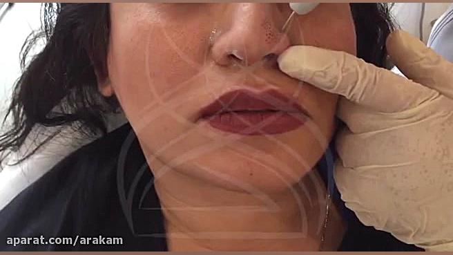 تصحیح فرم بینی