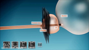 درمان سرطان پروستات با امواج ف...