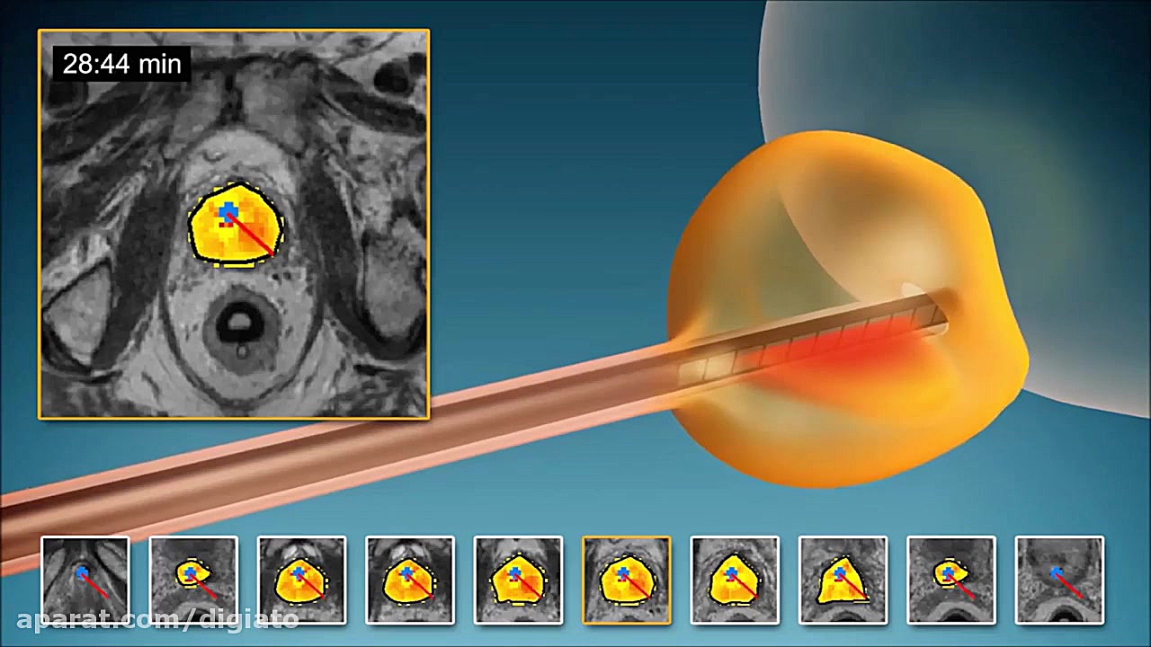 درمان سرطان پروستات با امواج ف...