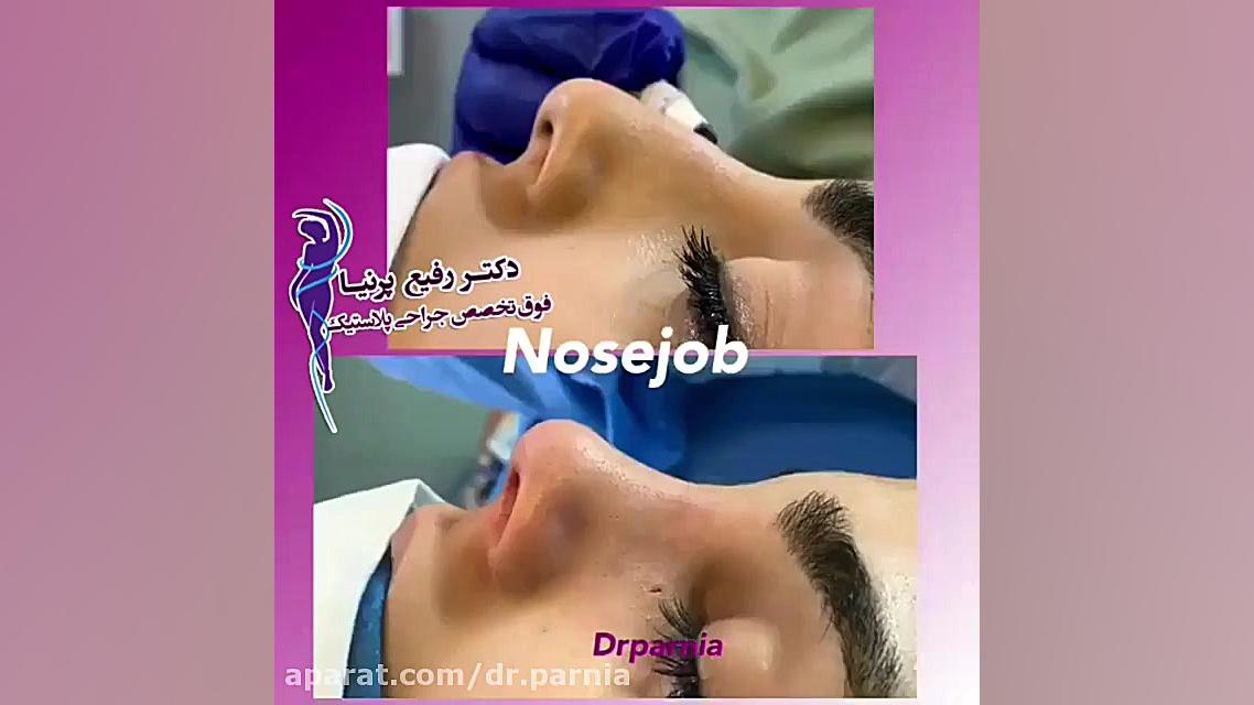 نمونه جراحی بینی استخوانی