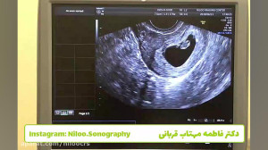 اولین ضربان قلب جنین