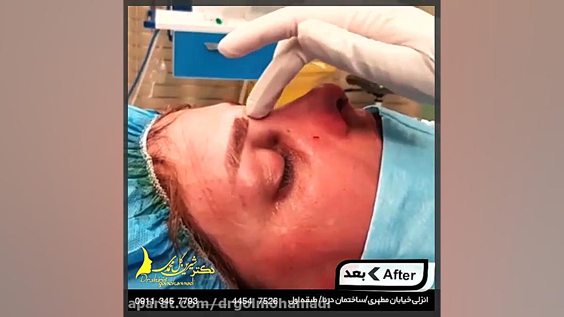 عمل جراحی بینی