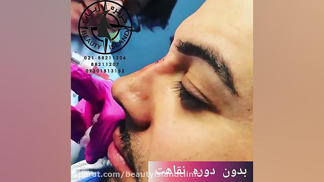 اصلاح فرم بینی بدون عمل جراحی