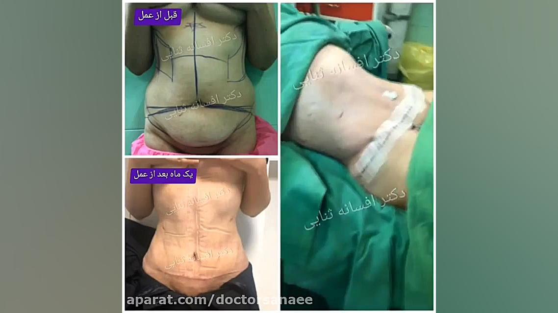 فیلم جراحی زیبایی شکم بدون نیا...