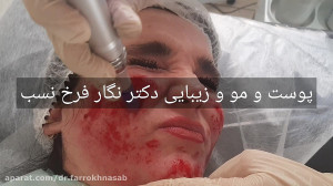 میکرونیدلینگ و جوانسازی پوست