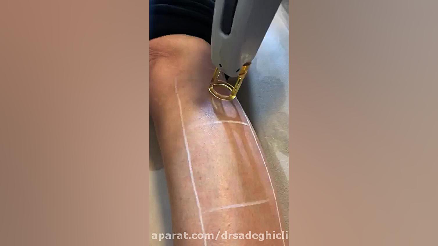 لیزر موهای زائد  دستگاه الکسان...