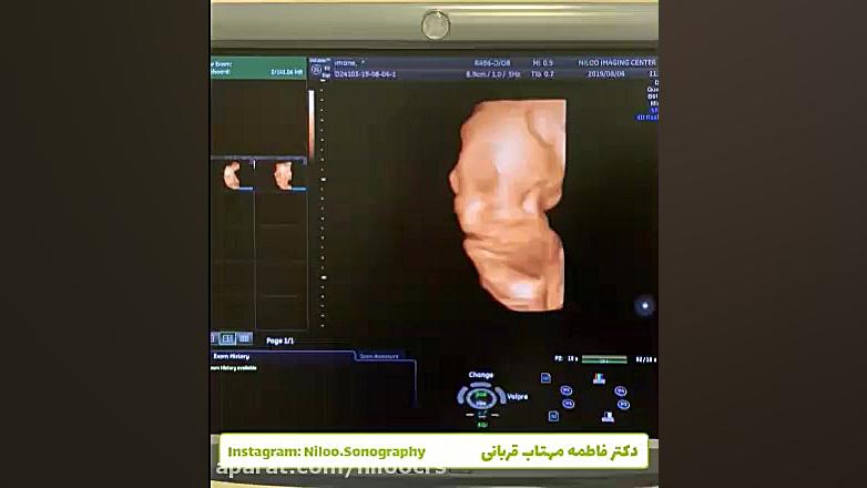 کنترل وزن جنین در هفته های آخر...