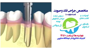 ایمپلنت و کاشت دندان دررشت.کلی...