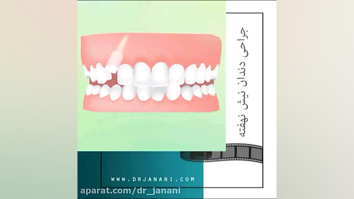 جراحی دندان نیش نهفته
