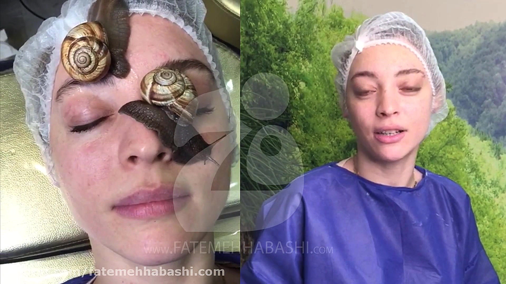 تاثیر خوب حلزون تراپی بر روی پ...