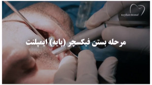 مرحله بستن فیکسچر (پایه) ایمپل...