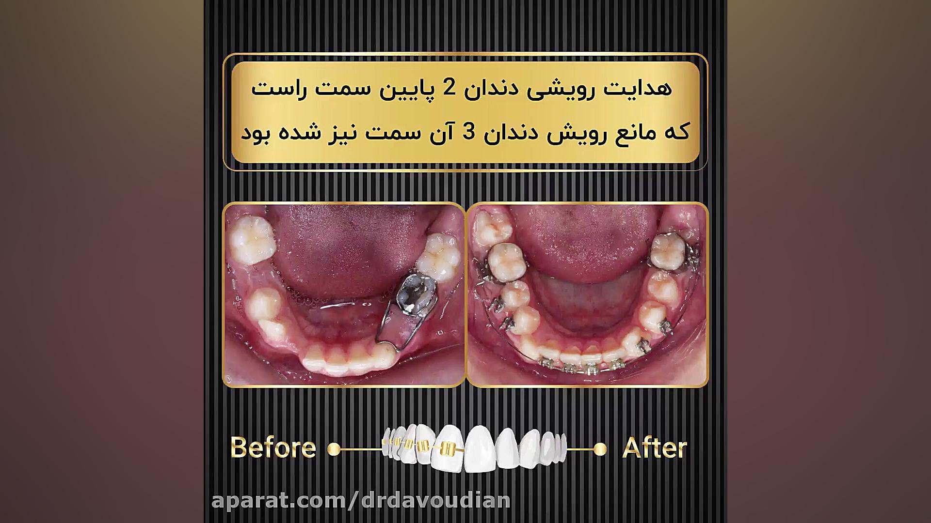 هدایت رویشی دندان ۲ پایین سمت...