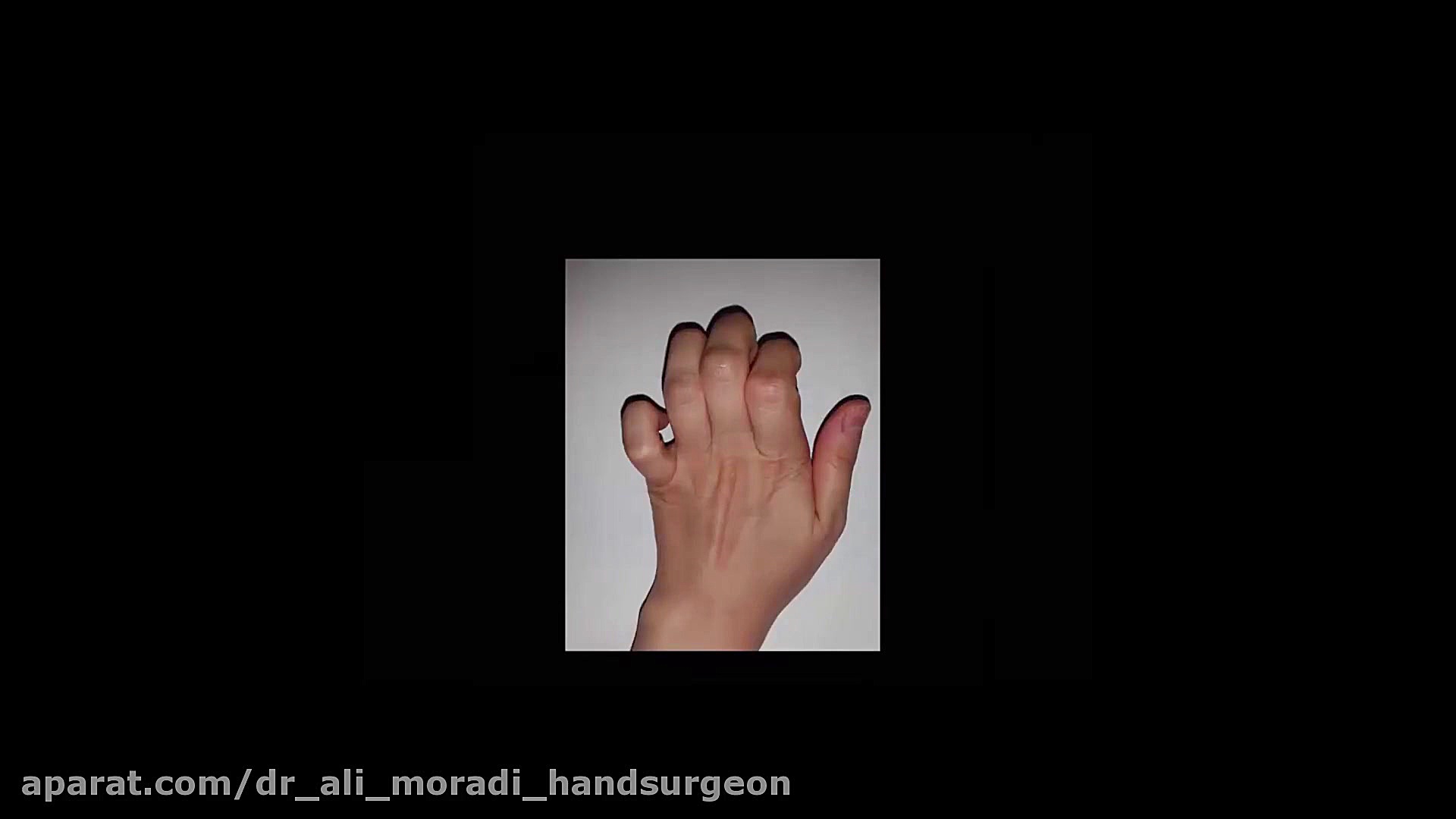 Extensor Tendon& 039;s Disease...