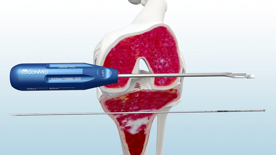 Soft Tissue ACL Reconstruction Using the Infinity™ Knee System