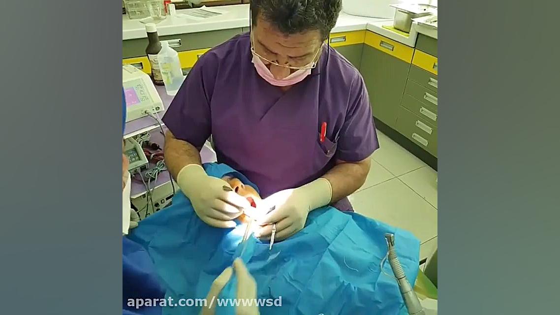 جراحی دندان نهفته فک بالا و پا...