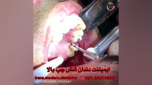 کاشت دندان |جراحی ایمپلنت