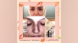 بعد از جراحی زیبایی بینی