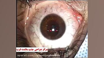 عمل جراحی چشم به روش لیزیک