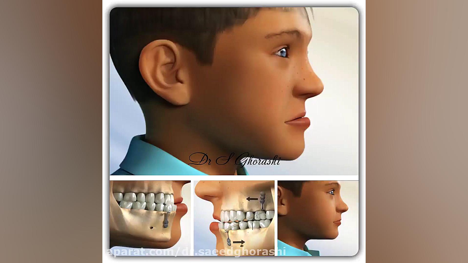 اصلاح ناهنجاري هاي عقب بودن فك...