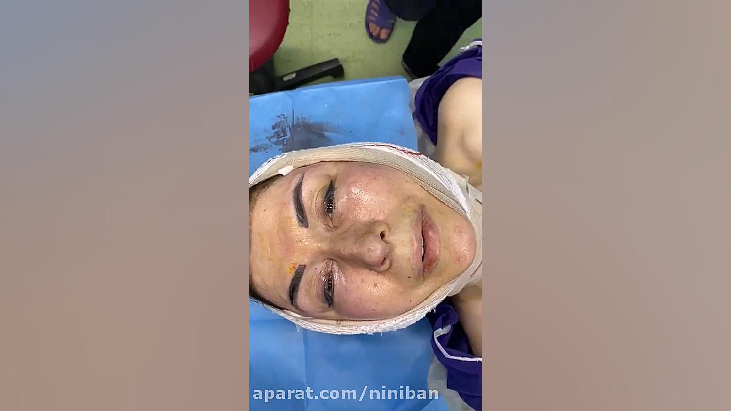 جراحی زیبایی صورت، بعد از عمل