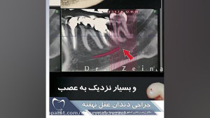 جراحي دندان عقل نهفته | دکتر ز...