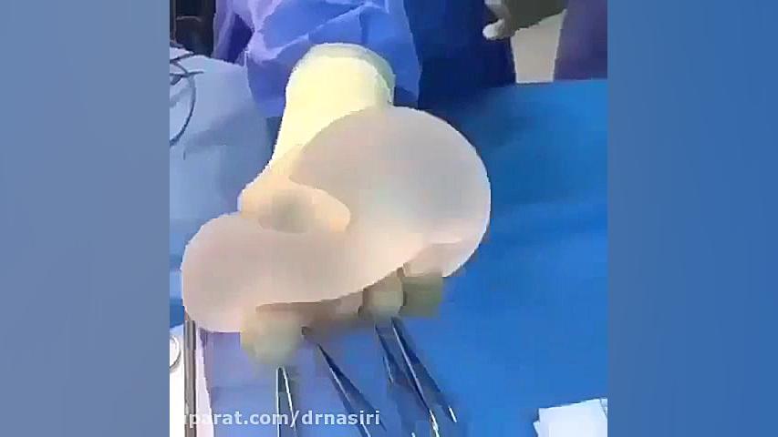 پارگی پروتز سینه