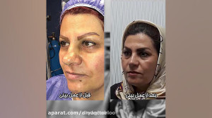 الو دکتر نمونه جراحی بینی دکتر...