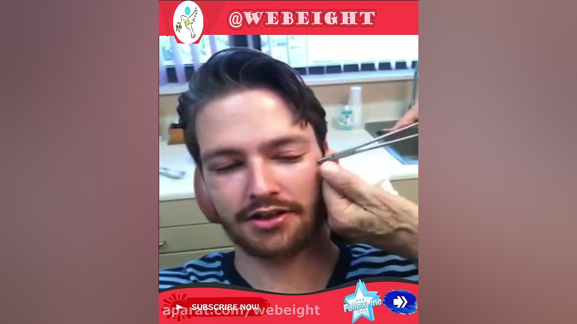 در آوردن پین 5 اینچی از صورت ت...