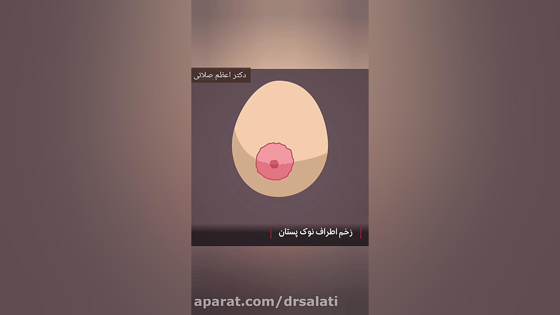 علائم سرطان سینه