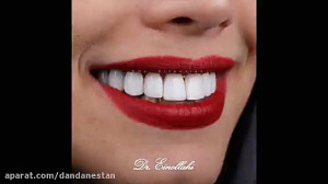اصلاح طرح لبخند با استفاده از...