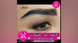 فیلم کاشت ابرو | کلینیک رز | 0...