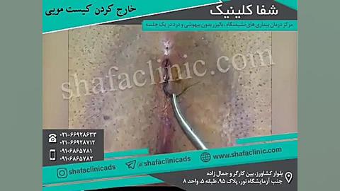 خارج کردن کیست مویی | شفا کلین...