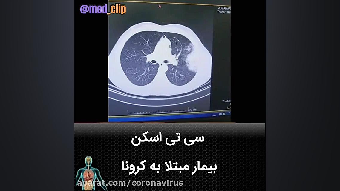 سی تی اسکن بیمار مبتلا به کرون...