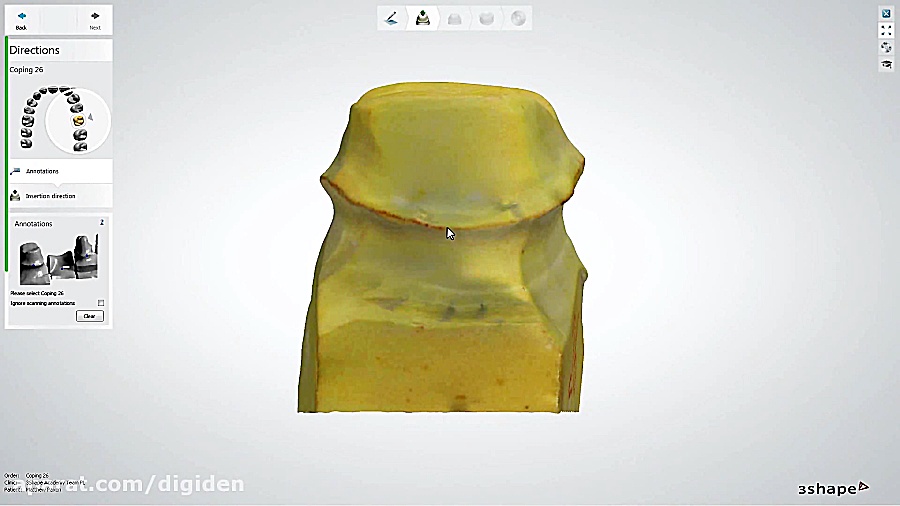 طراحی کوپینگ تک واحدی در دنتال...