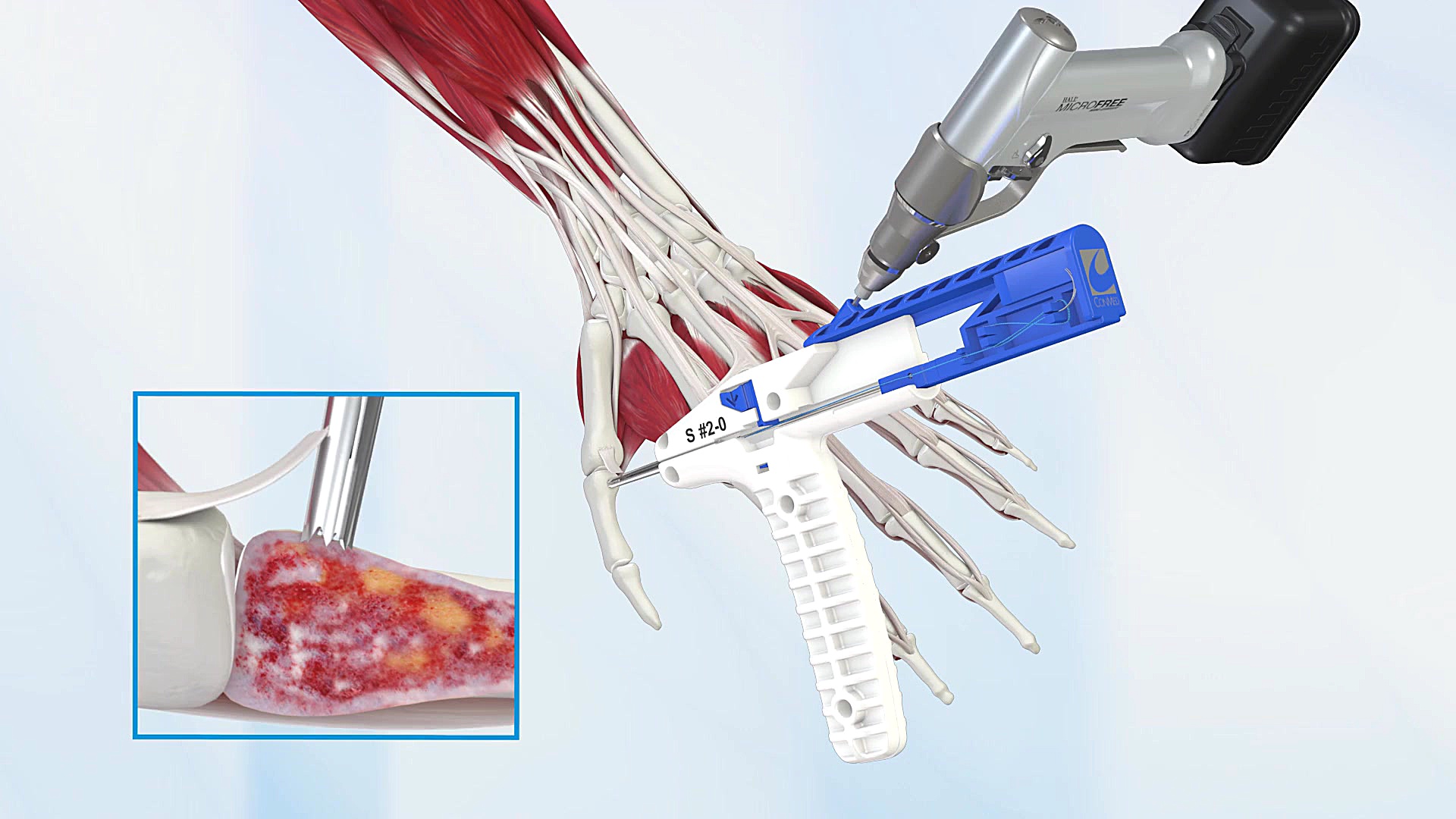 Y Knot&reg; All Suture Anchor...