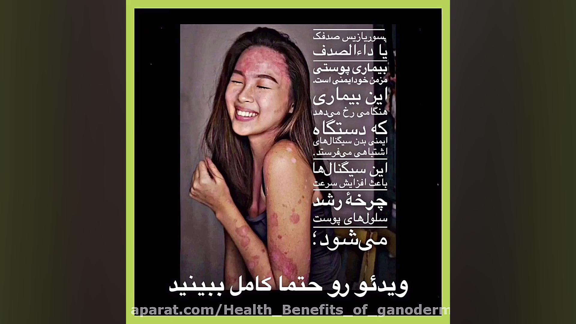 پسوریازیس بیماری قابل درمان یا...