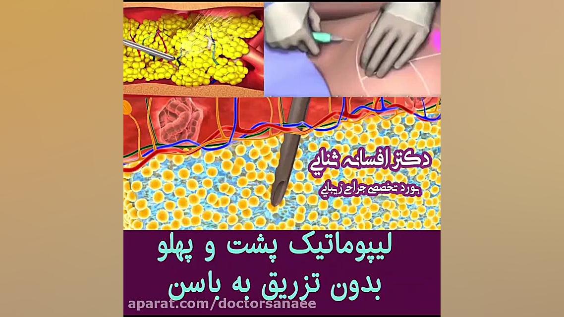 فیلم لیپوماتیک شکم و پهلو