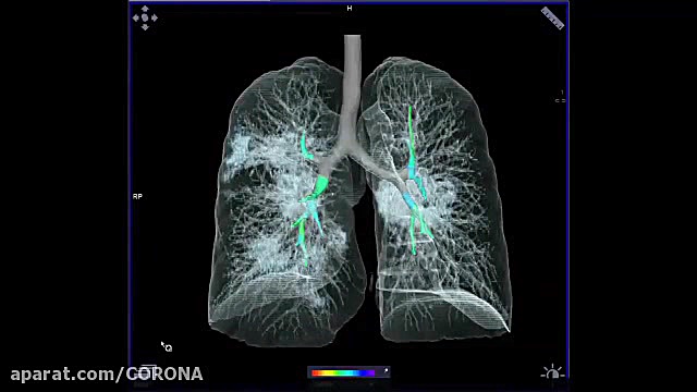 ریه&zwnj;های یک فرد مبتلا به ک...