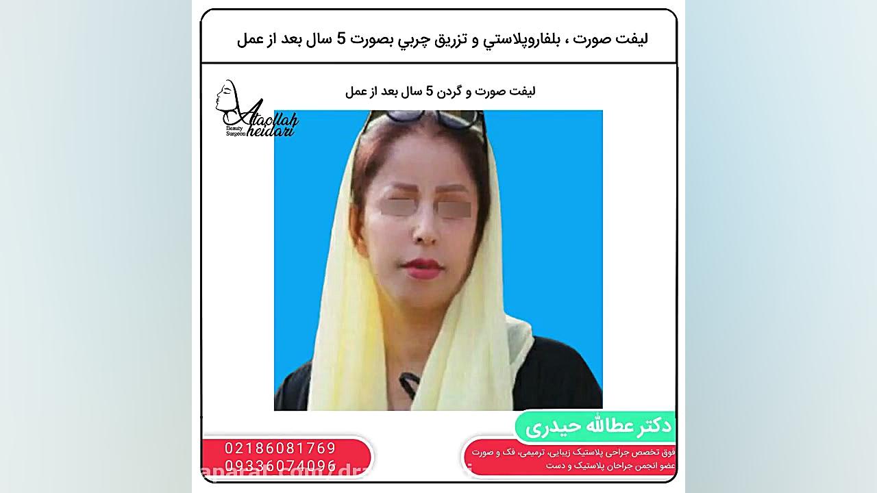 لیفت صورت، بلفاروپلاستی و تزری...