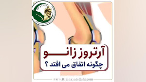 علل بروز آرتروز زانو و نحوه در...