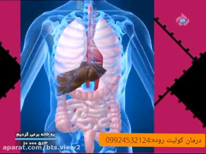 ایا میدانستید کولیت روده منجر...