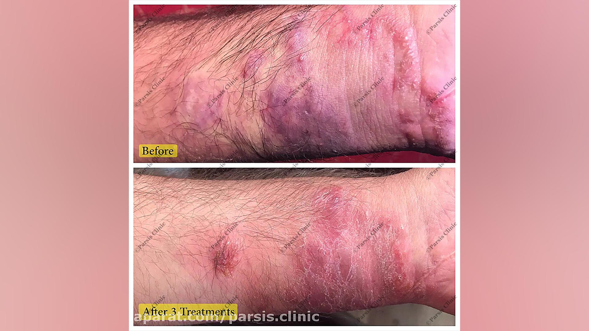 درمان بیمارى بیماری سالک