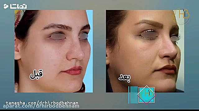 فیلم واقعی عمل ترمیم بینی