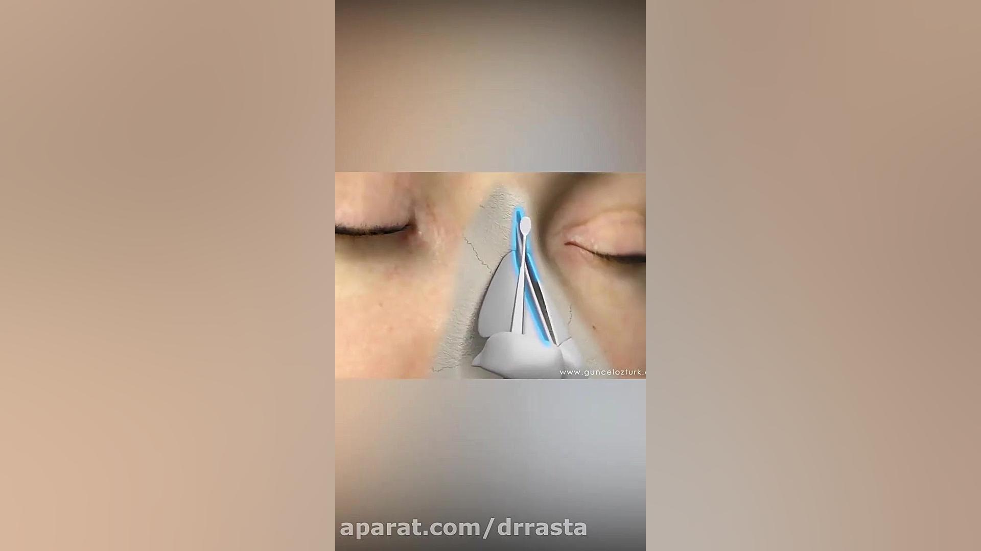 جراحی زیبایی بینی در اتاق عمل